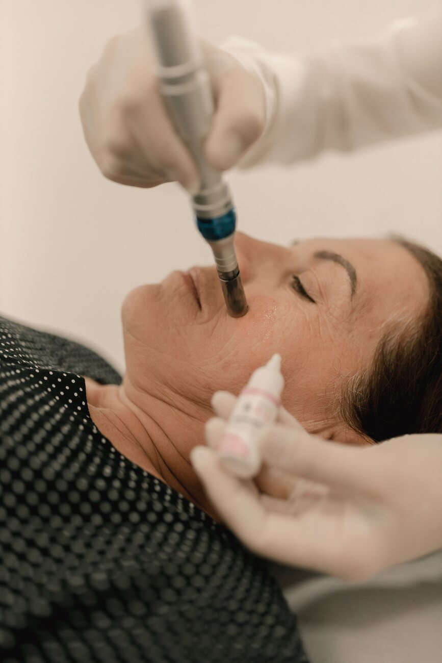Microneedling uitgelicht: wat het is en voor wie