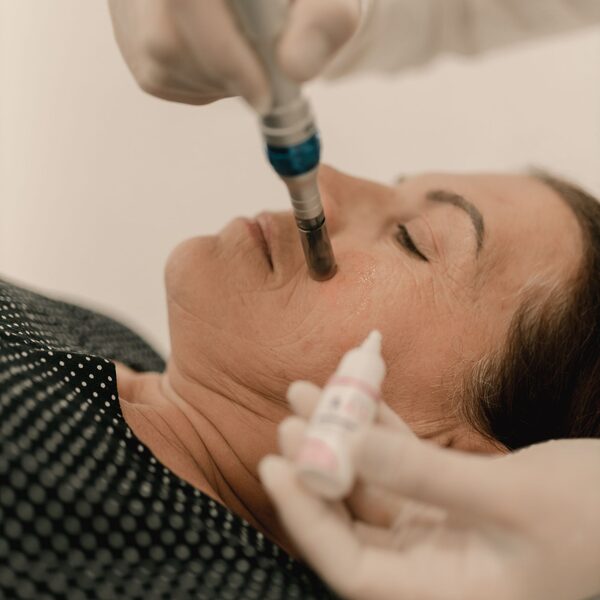 Microneedling uitgelicht: wat het is en voor wie